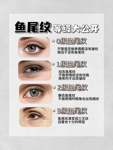 鱼尾纹出现意味着老了？其实它与性格及形成原因有关(图2)