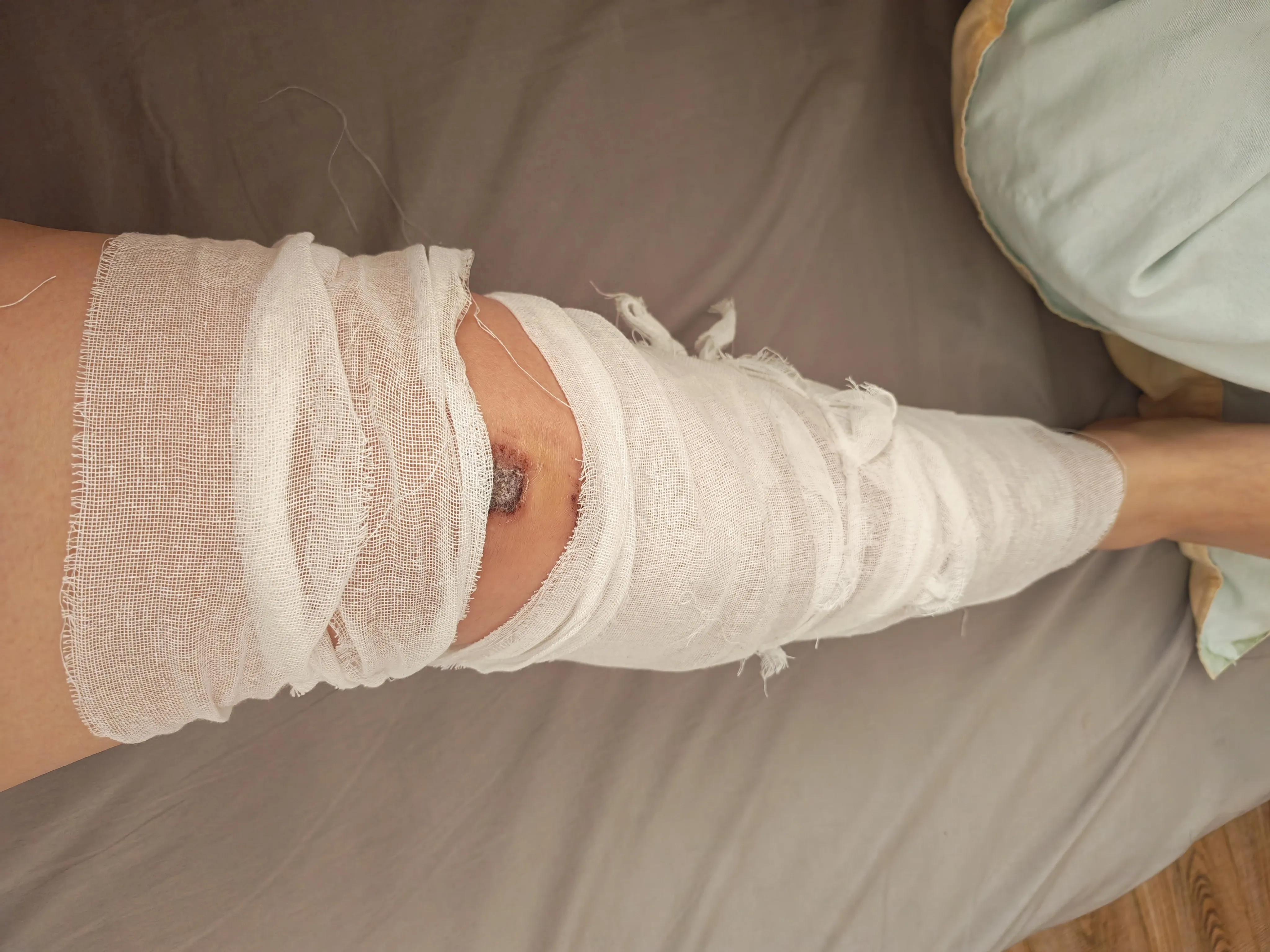 骨折躺床上没收入？分享真实踩坑经历，帮你避开骗局